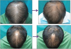 تأثیر کوکتل مو بر رشد مو در دو گروه