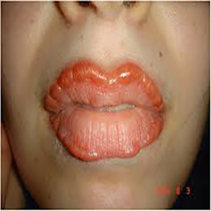 عوارض آلرژیک شیدینگ لب 